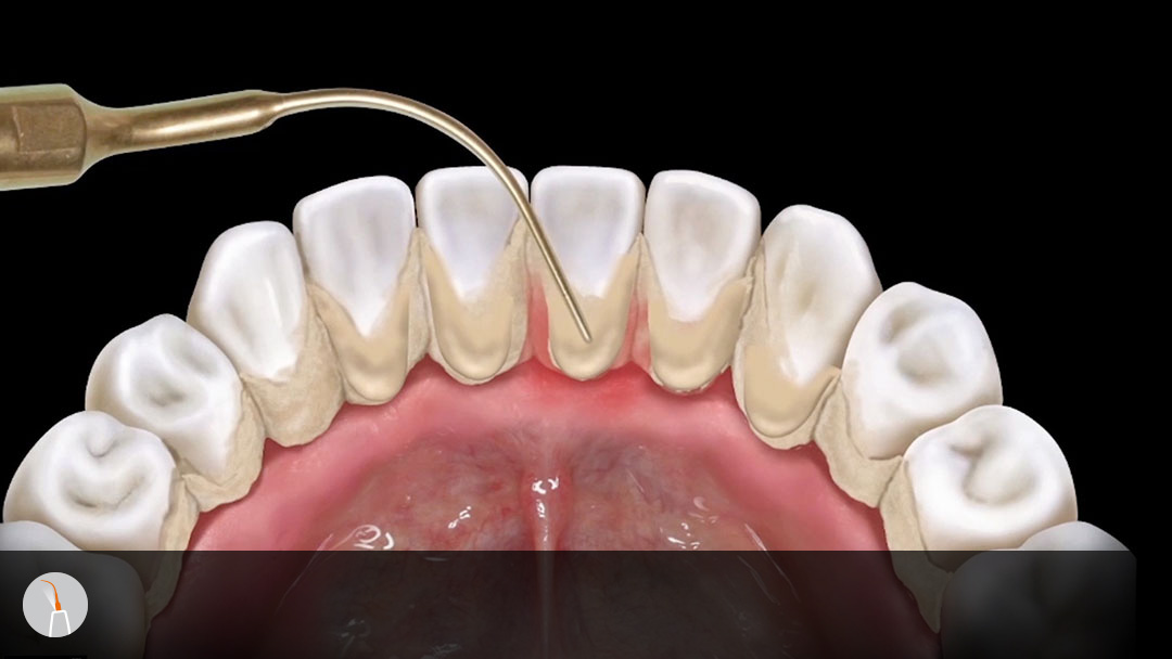 subgingival calculus removal