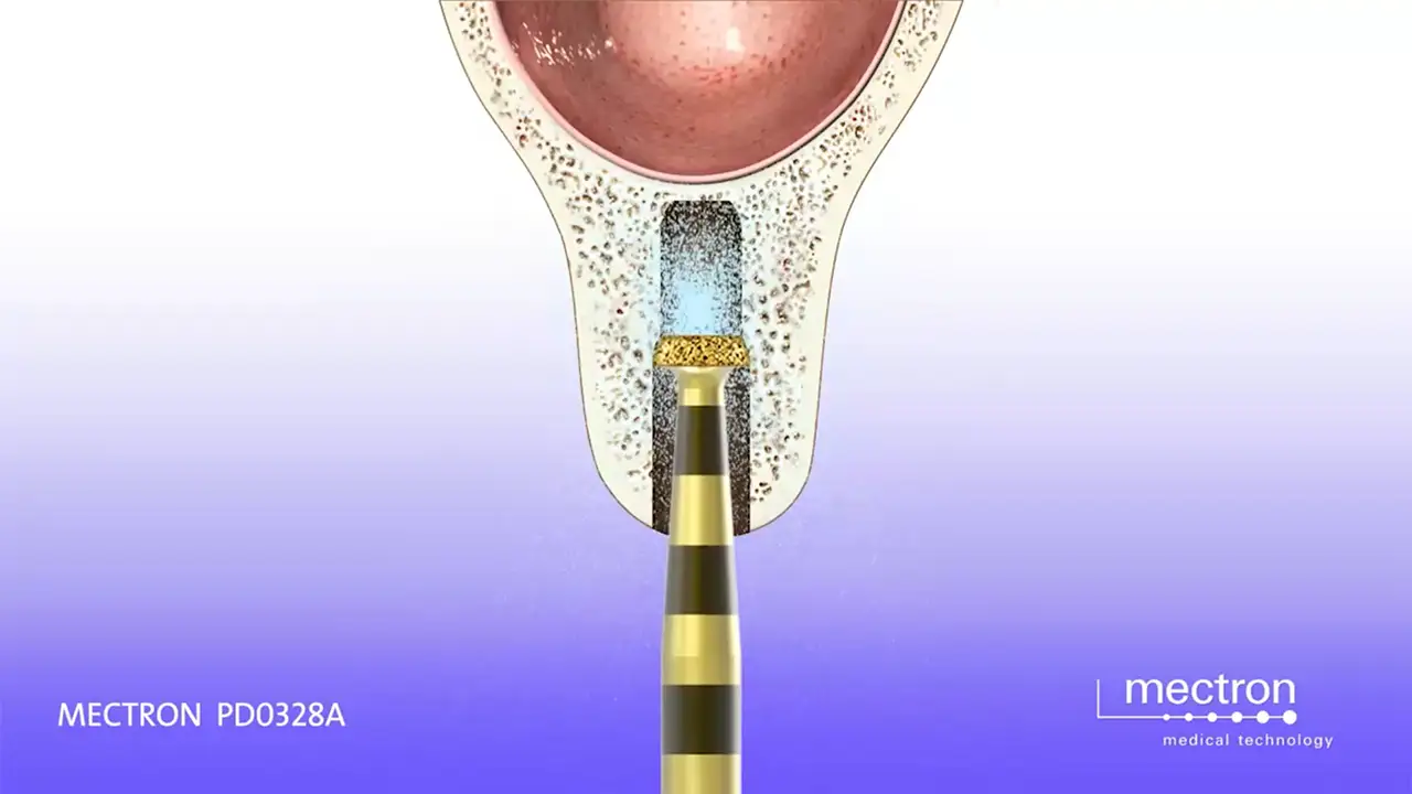 PIEZOSURGERY - Dr. Fabrizio Fontanella - Horizontal tooth extraction technique