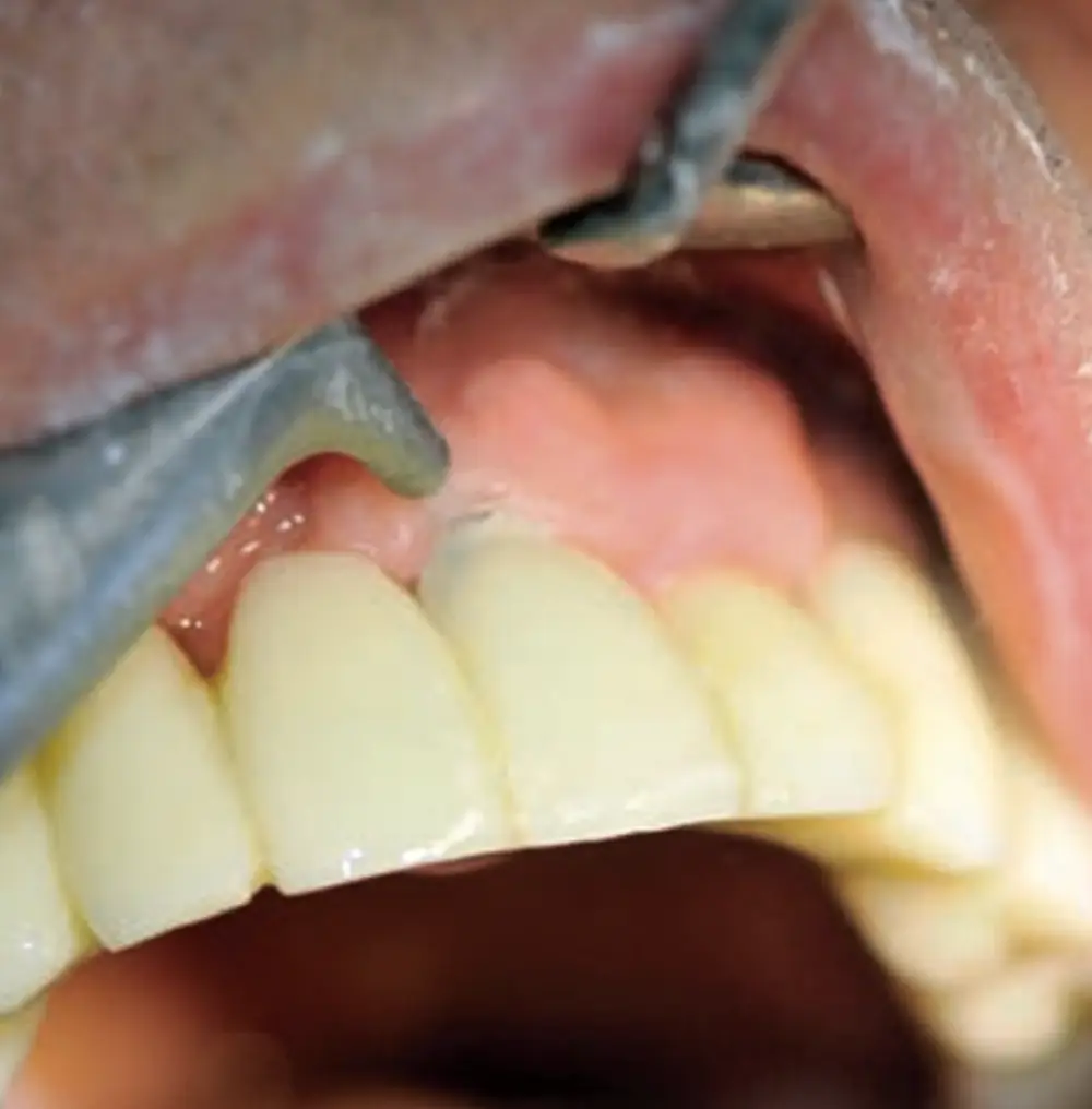 Ultrasonic cervical finishing – atraumatic and precise